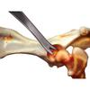 Jorgensen Femoral Head Disarticulator